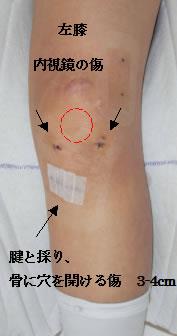 前十字靭帯再建術（ACL）