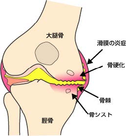 変形性膝関節症とは