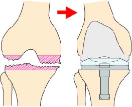 人工膝関節形成術とは