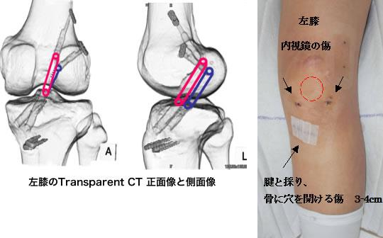 靭帯再建方法について